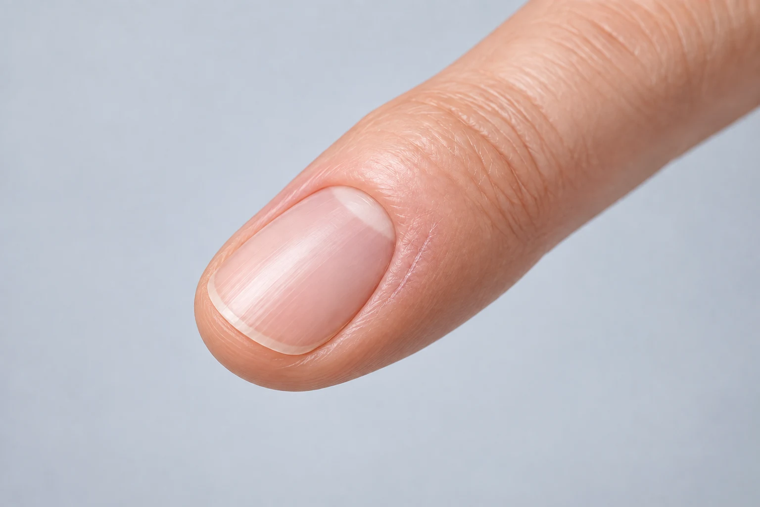Abgeheilter Finger nach Entfernung einer Mukoidzyste